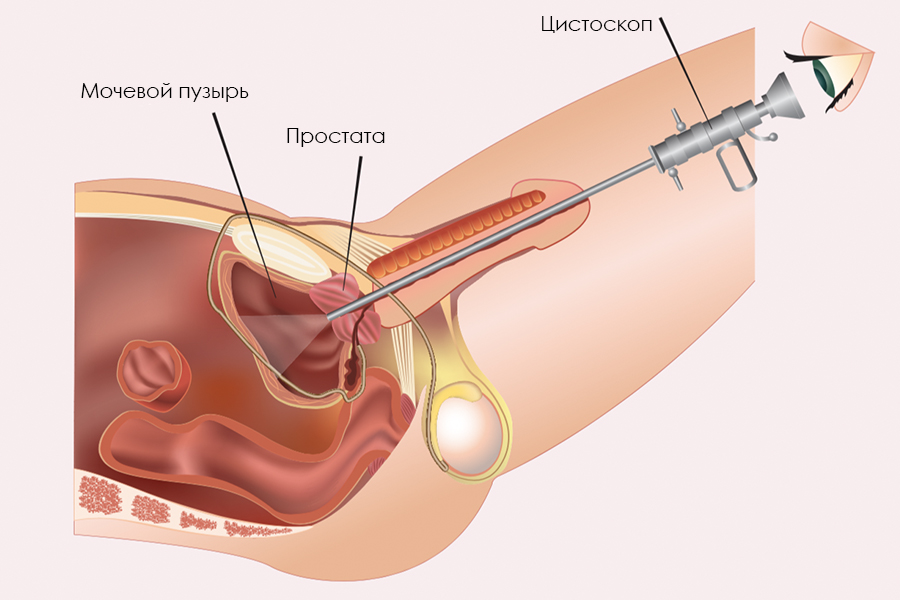 схема цистоскопии цистоскопия