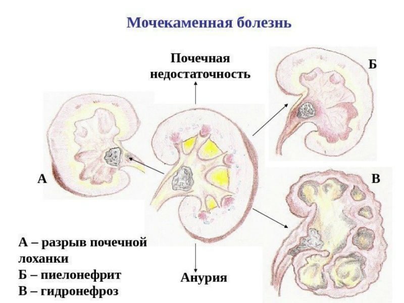 Мочекаменная болезнь