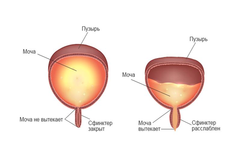 Сфинктерная дисфункция