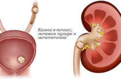 Чем питаться при мочекаменной болезни почек, чтобы не навредить себе