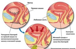 Цистит у женщин – симптомы, признаки, лечение