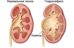 Гидронефроз — причины, симптомы, диагностика и лечение