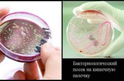 Кишечная палочка в моче у женщин — причины и лечение