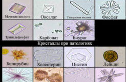 Кристаллы солей в моче — что это значит