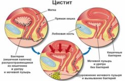Может ли передаться цистит от женщине к мужчине и наоборот