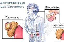 Надпочечниковая недостаточность (гипокортицизм): причины, симптомы и лечение