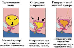 Недержание мочи у женщин — виды, причины, варианты лечения