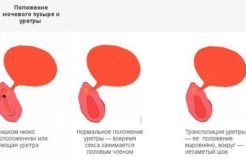 Посткоитальный цистит — причины, симптомы, диагностика и лечение