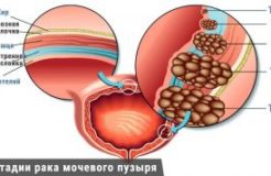 Рак мочевого пузыря-стадии, симптомы, диагностика