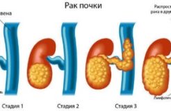 Рак почки: симптомы и признаки у мужчин и женщин, прогноз при опухоли и лечение на разных стадиях онкологии