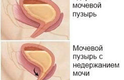 Старческое недержания мочи у пожилых женщин