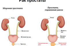 Учащённое мочеиспускание — причины, признаки и лечение